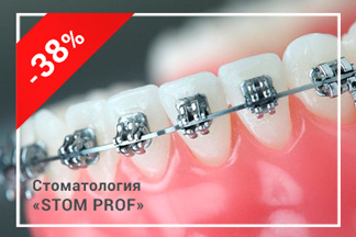 Скидка 38% на установку брекетов + подарок